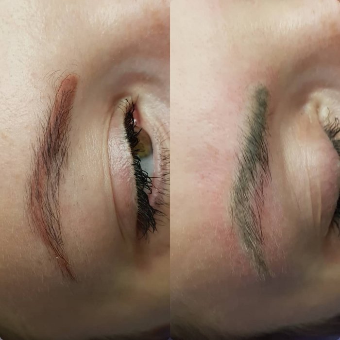 Заживление после ремувера на бровях