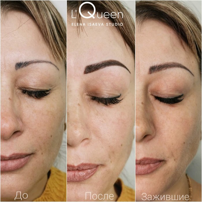 Перекрытие или удаление татуажа