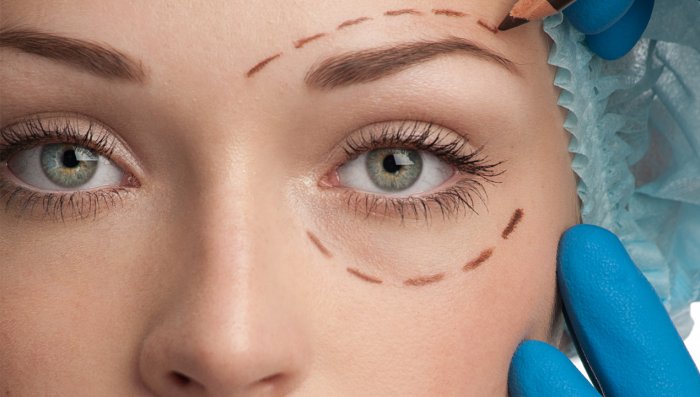 Нависшее верхнее веко блефаропластика