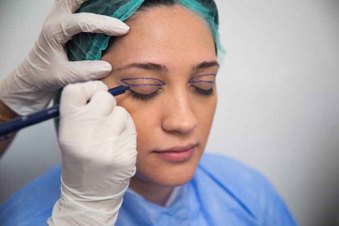 Пластическая операция век