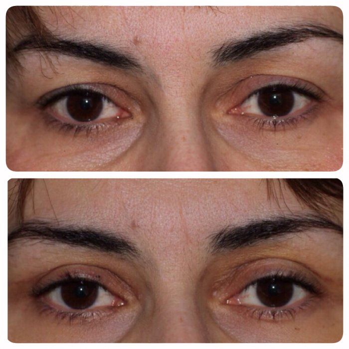 Операция на веках пластика