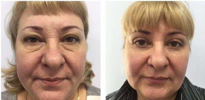 Коррекция Нижнего века