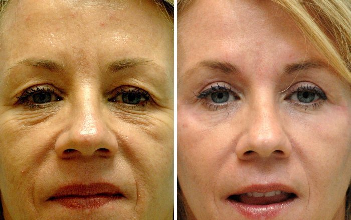 Блефаропластика верхних век до и после