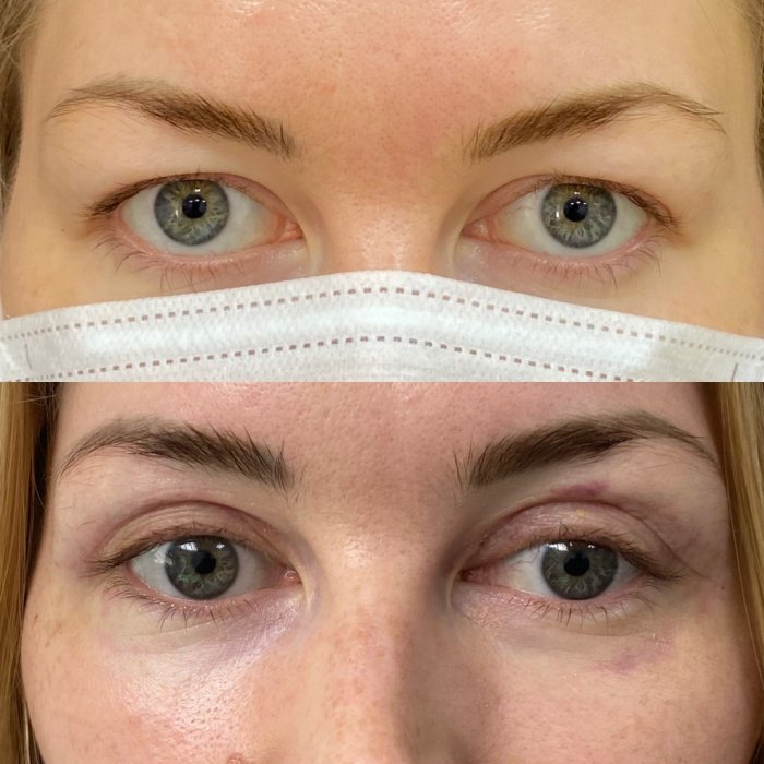 Пластика верхних век верхняя блефаропластика