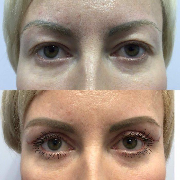 Некачественная блефаропластика