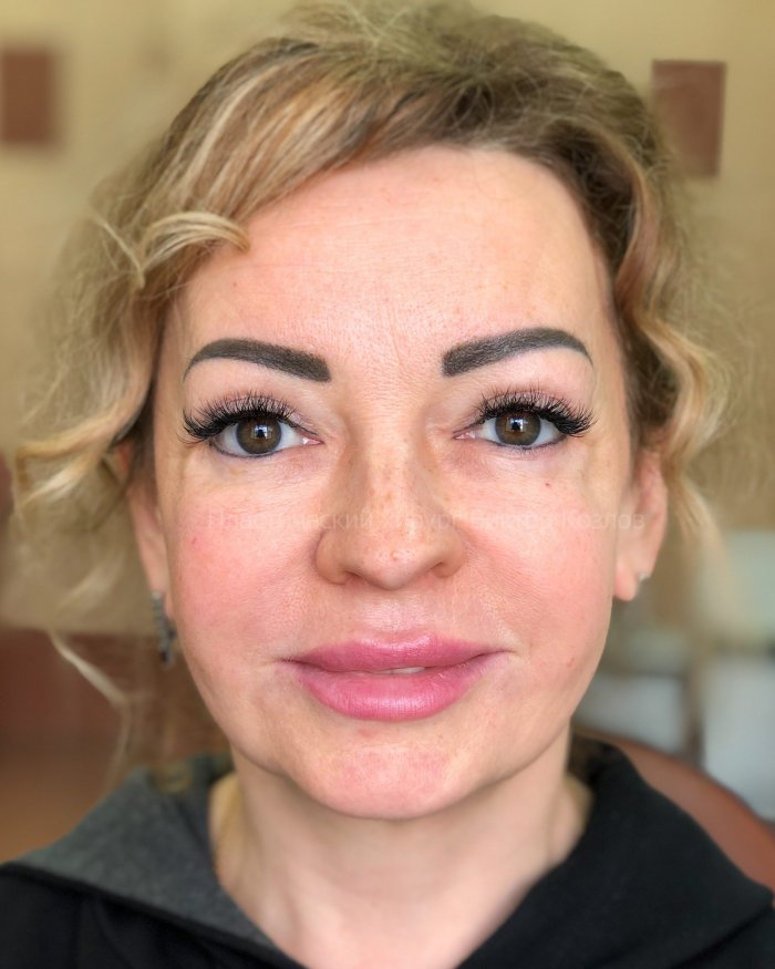 Блефаропластика в Тольятти