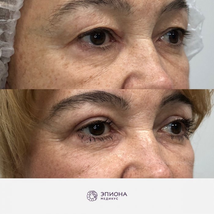 День ботокса