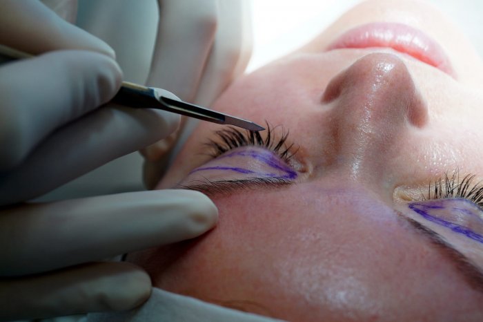 Блефаропластика реклама