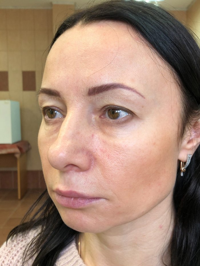 Квадрилатеральная блефаропластика что это такое