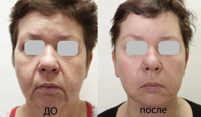 Блефаропластика нижних век в Москве