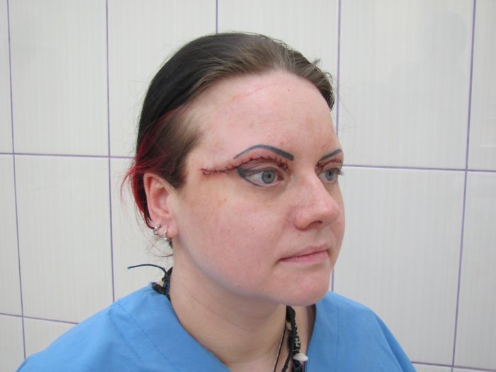 Верхняя блефаропластика техника