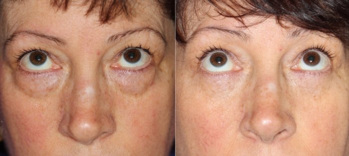 Верхнее веко косметология