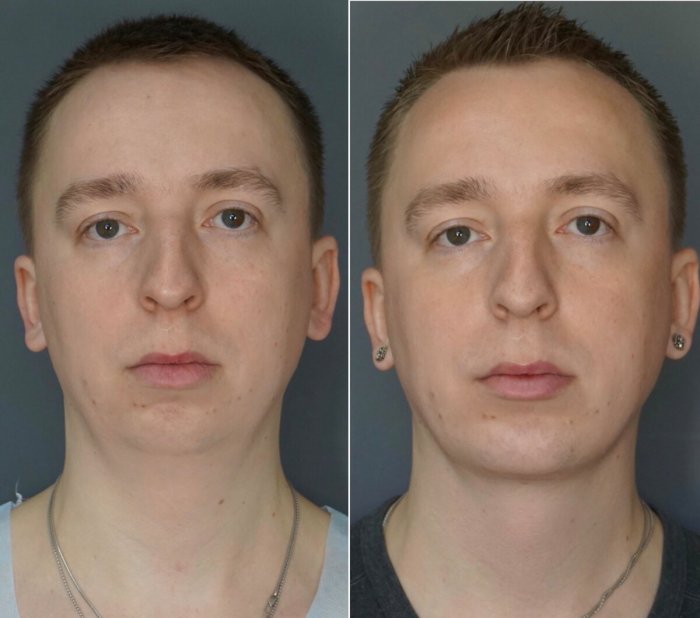 Пластиковая операция лица