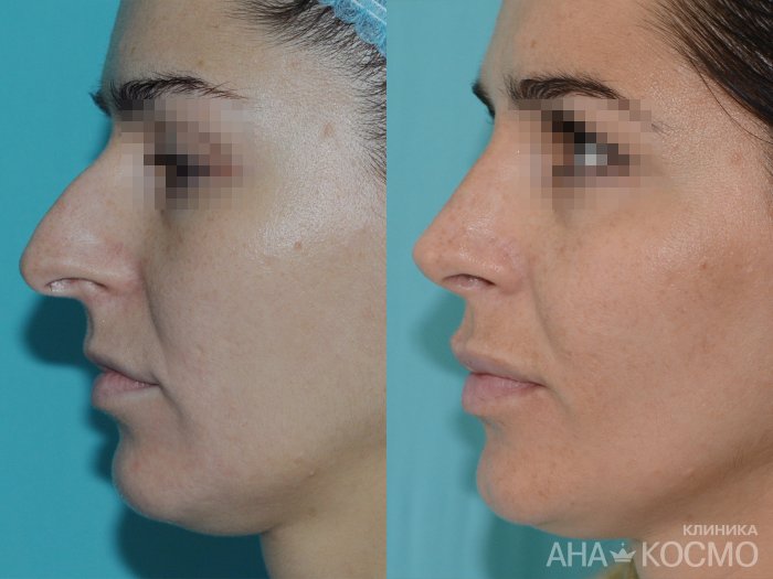 Пластическая операция на нос с горбинкой