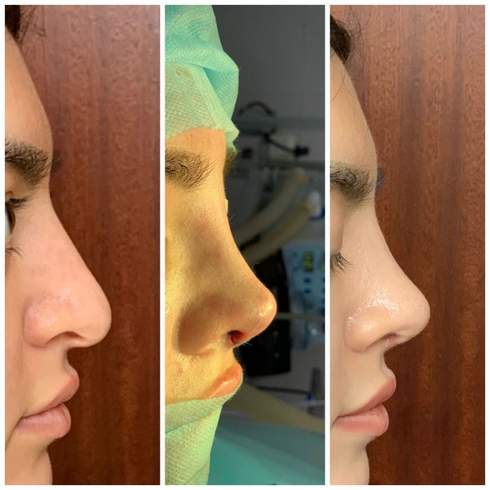 Давудов Иса ринопластика