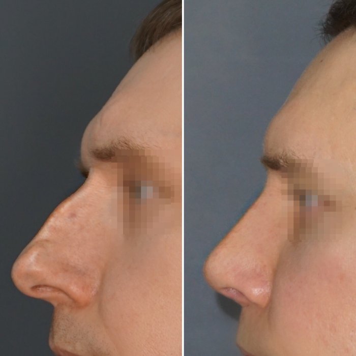 Реконструктивная ринопластика