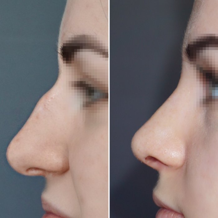 Хайбула Камилович ринопластика