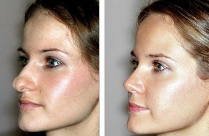 Аугментационная ринопластика