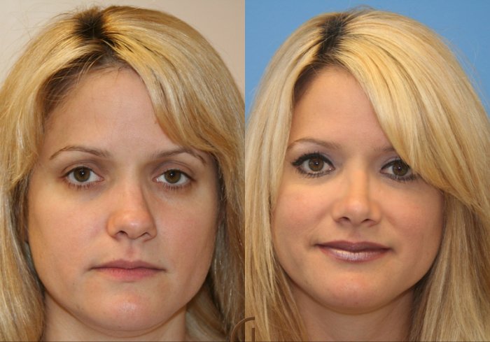 Пластика носа Самара