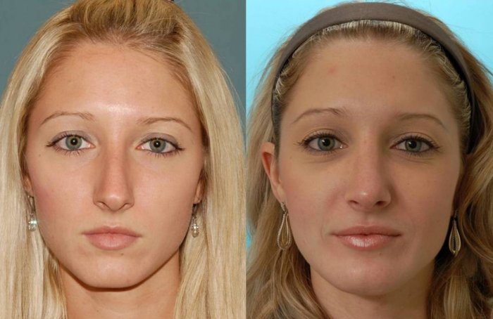 Аугментационная ринопластика