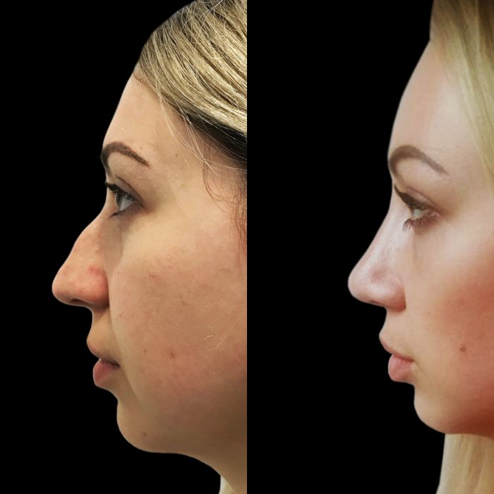 Пластическая операция на нос