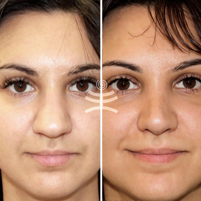 Аугментационная ринопластика