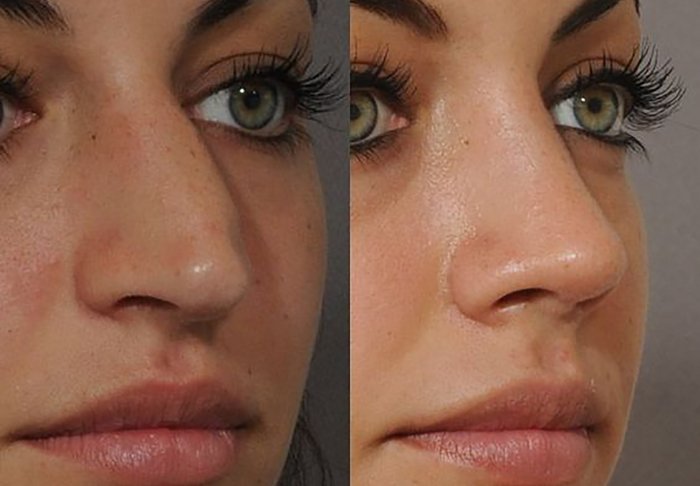 Красивые женские носы после ринопластики