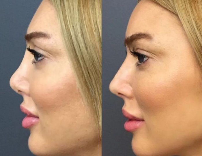 Безоперационная ринопластика филлерами