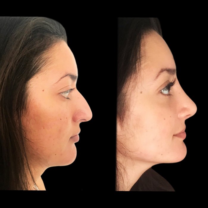 Савинков ринопластика