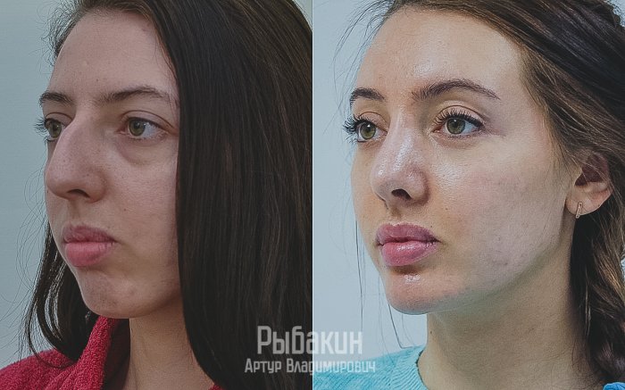 Блефаропластика и ринопластика