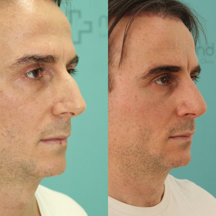 Хирургическая пластика носа