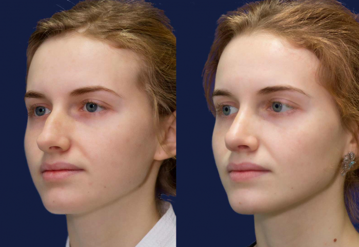 Нос до и после ринопластики
