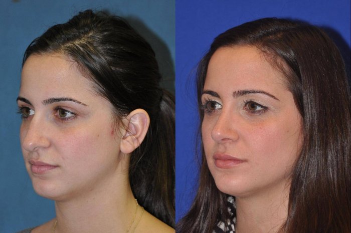 Ринопластика кончика носа