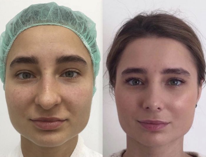 Пластическая операция носа до и после