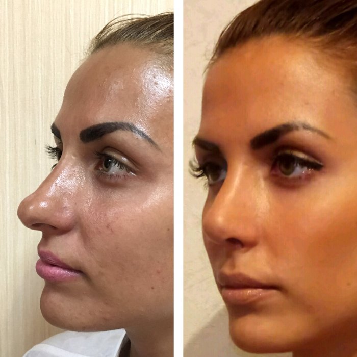 Операция носа ринопластика