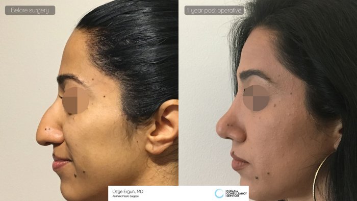 Нос с горбинкой у девушки