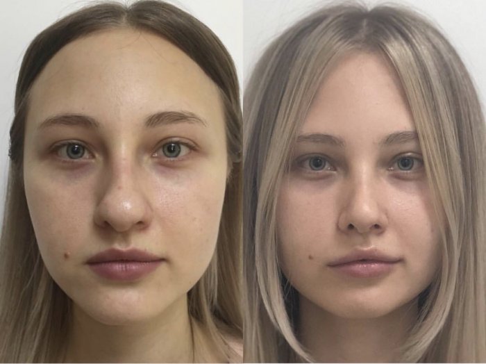 Лина Алиевна Исбир ринопластика