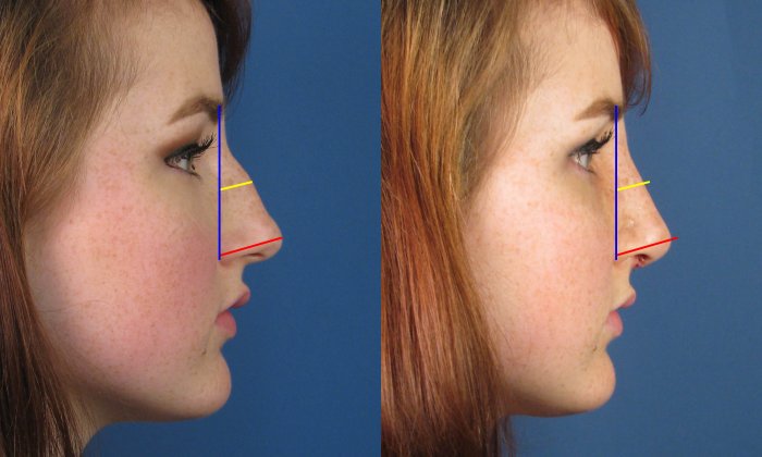 Безоперационная ринопластика горбинки носа