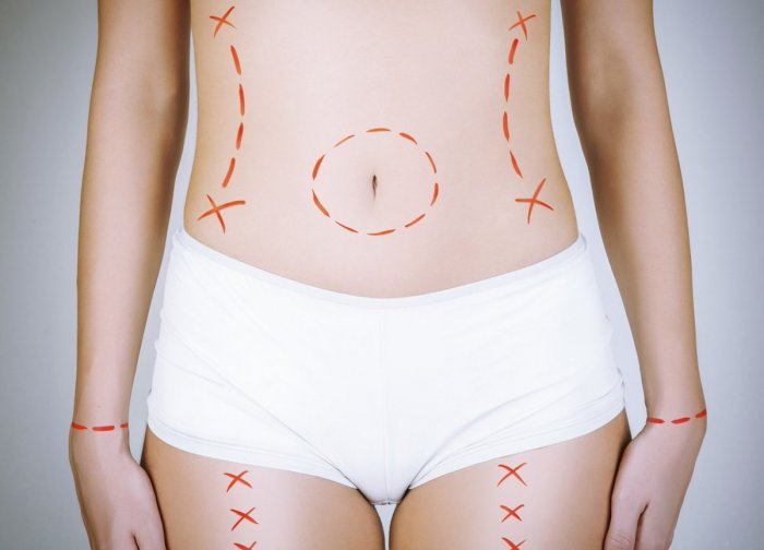 Разметка перед пластической операцией