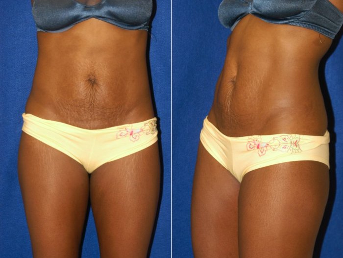 Операция по липосакции