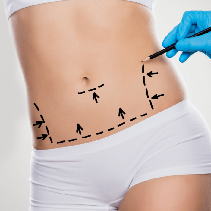 Хирургическая пластика живота