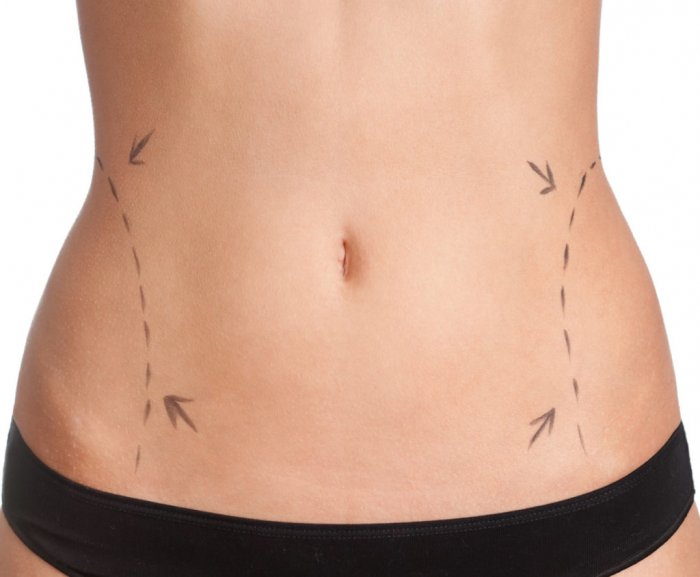 Безоперационная подтяжка живота