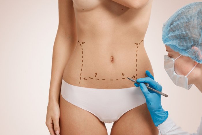 Пластическая хирургия липосакция