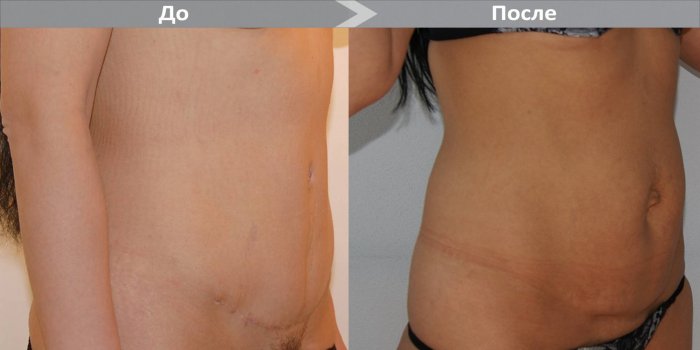 Пластика живота абдоминопластика