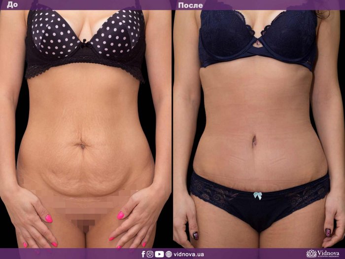 Миниабдоминопластика шрам