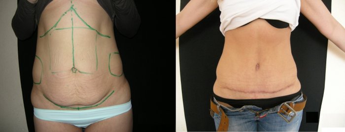 Абдоминопластика разметка