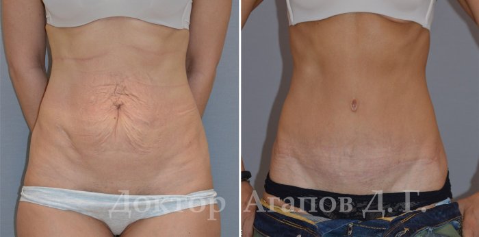 Мини абдоминопластика шрамы