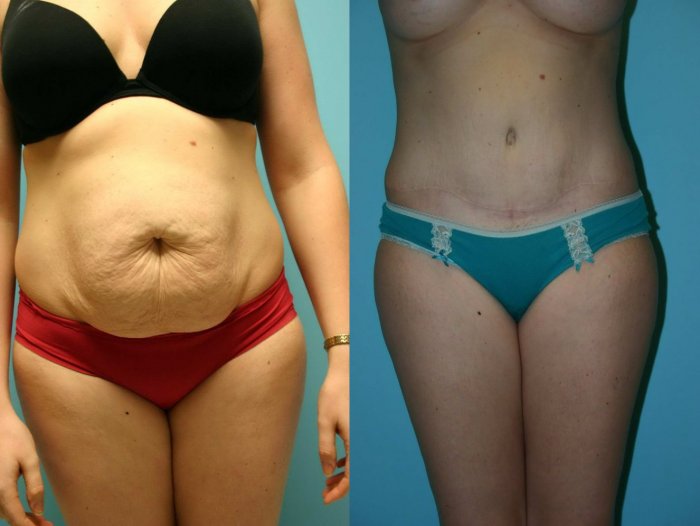 Миниабдоминопластика живота