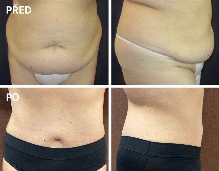 Абдоминопластика живота