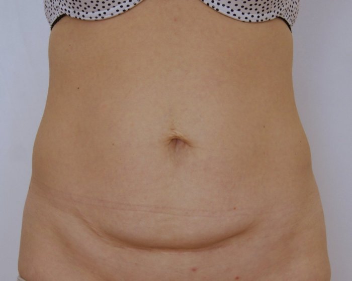 Миниабдоминопластика с диастазом